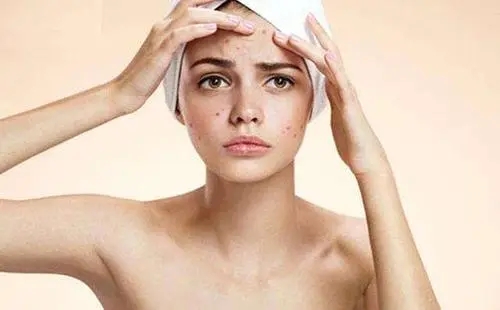 脸上长痘痘文案