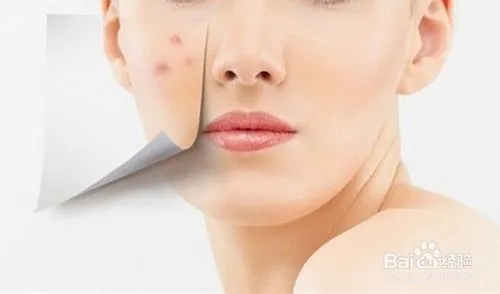 写一条祛痘文案关于朋友圈的