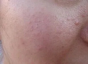 脸上长痘的搞笑说说文案